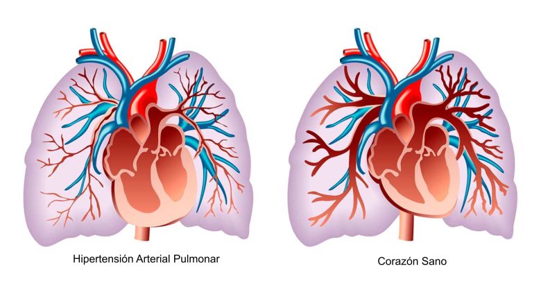 Hipertensión Arterial Pulmonar