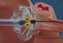 ablación por campo pulsado