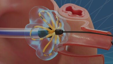 ablación por campo pulsado