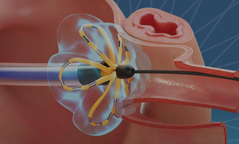 ablación por campo pulsado