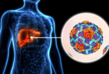 Hepatitis