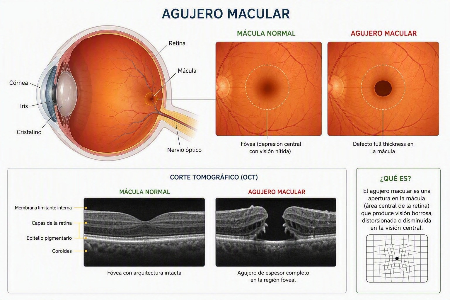 Agujero macular